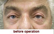 plastic-surgery-blepharoplasty